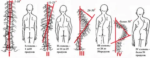 Как остеопат помогает при детском сколиозе