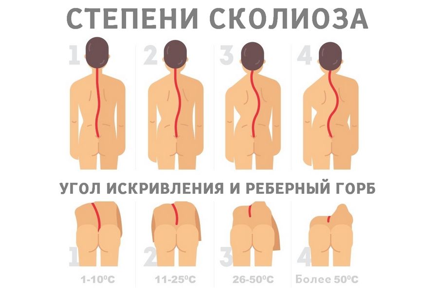 Степени сколиоза. Угол искривления