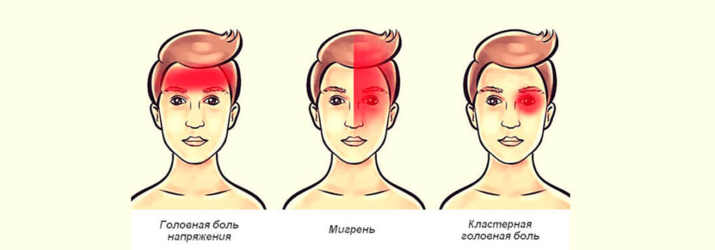 Чем головная боль напряжения отличается от мигрени и других видов боли?